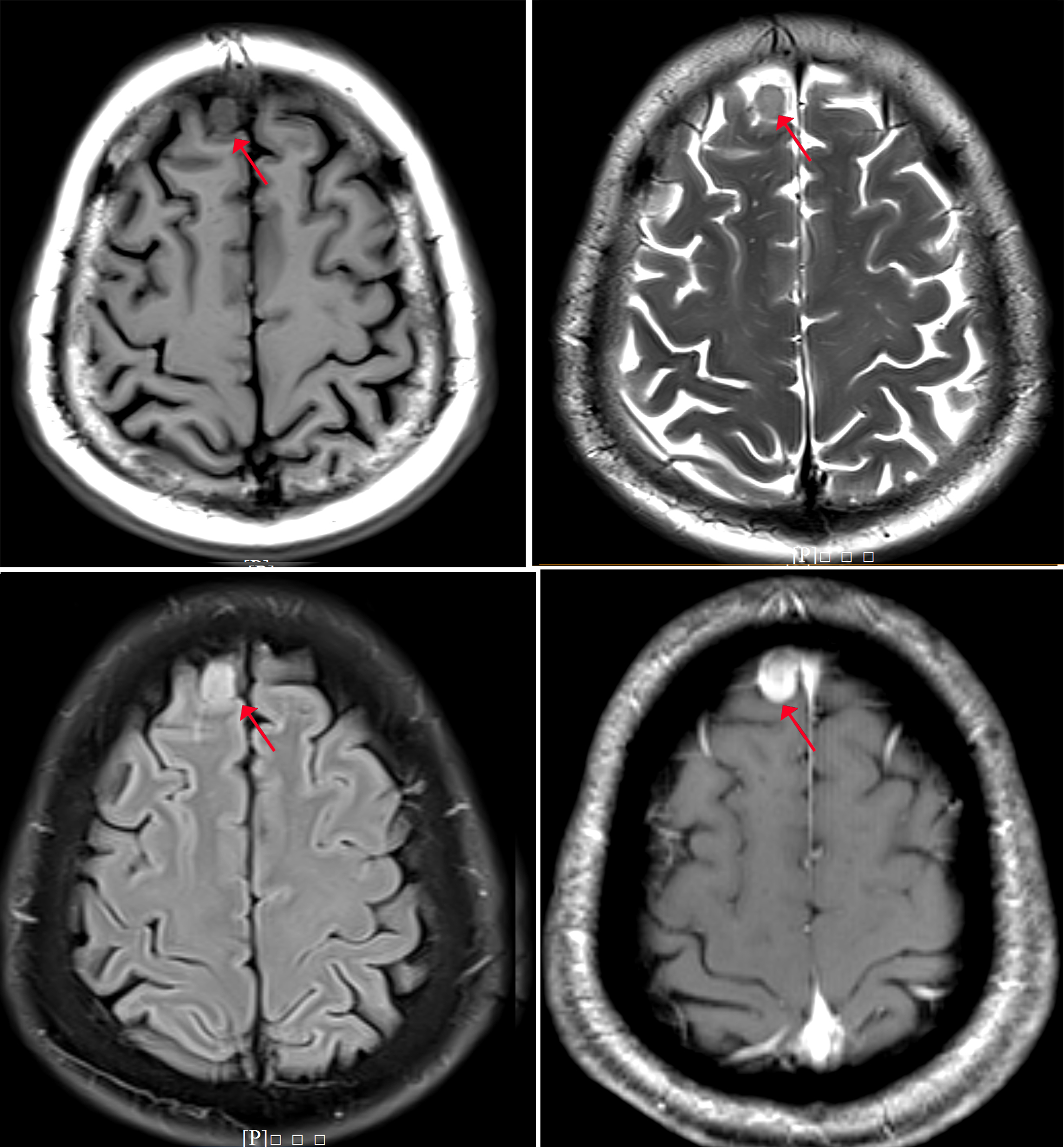 基于局部-全局自适应信息学习的脑肿瘤磁共振图像分割