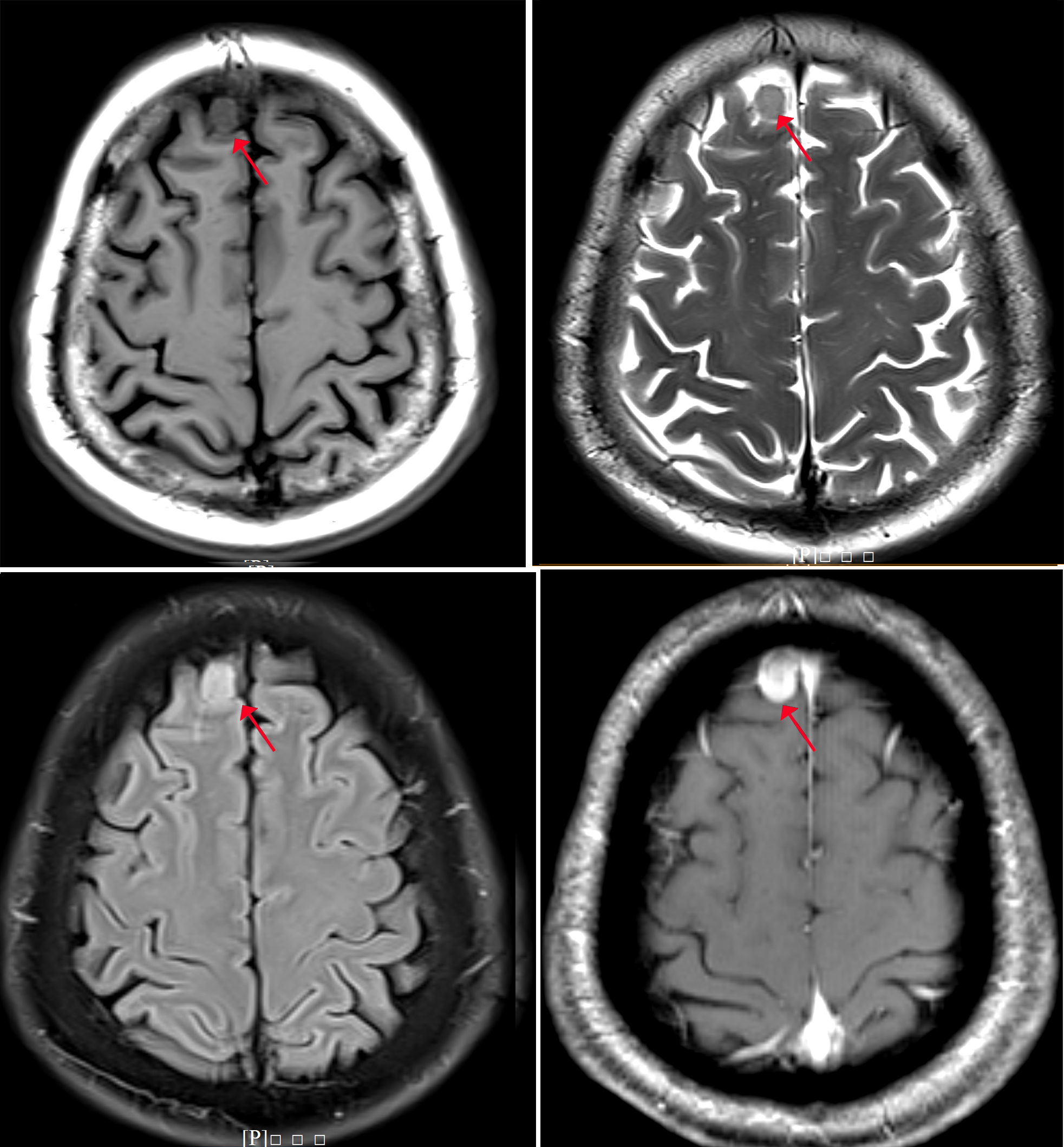 典型脑出血病例分享（含CT及MRI） - 病例中心(诊疗助手) - 爱爱医医学网